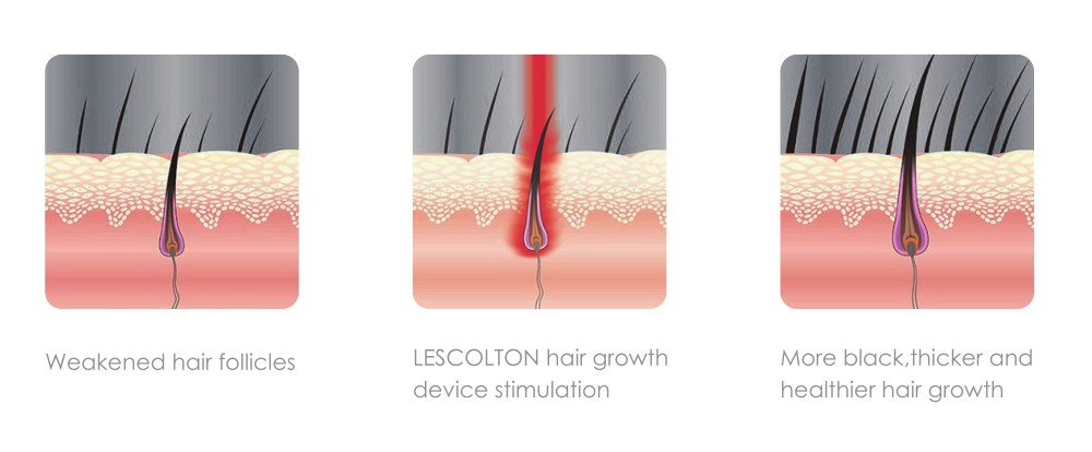LESCOLTON LS-D601 Anti Hair Loss Laser Hair Regrowth Helmet for Hair Loss Medical Diodes Hair Regrow Treatment