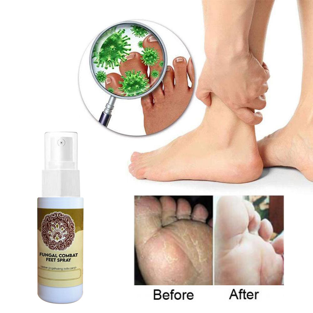 Herbal Antipruritic Sweaty Foot & Athlete's Foot Spray